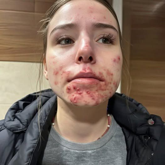 The Hidden Reasons You Keep Getting Pimples on Your Chin — And How to Finally Stop Them – theonlinestory.com