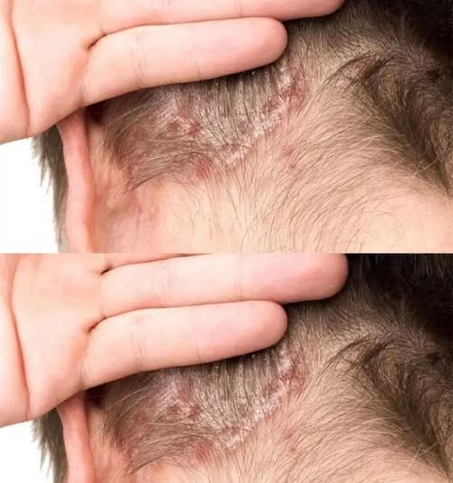 Found this on my son’s scalp. Have no idea what it is and we can’t get a doc appt soon. Tips?